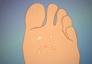 Illustration of a foot with plantar warts